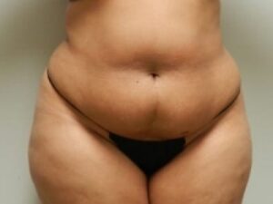 Before Image: Bella Body Lift