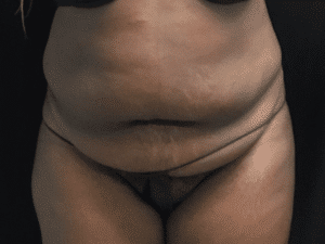 Before Image: Bella Body Lift
