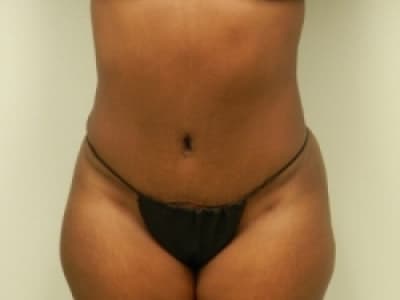 After Image: Bella Body Lift