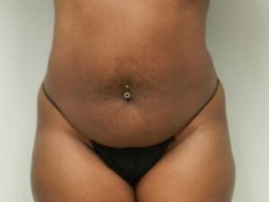 Before Image: Bella Body Lift