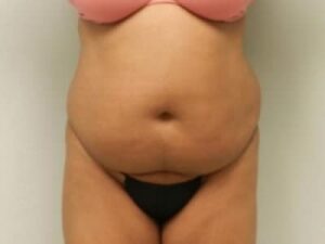 Before Image: Bella Body Lift