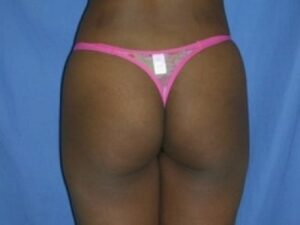 Before Image: Buttock Augmentation