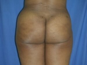 After Image: Buttock Augmentation