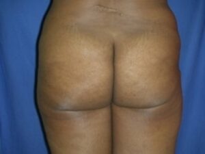 Before Image: Buttock Augmentation