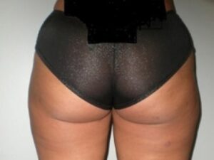 After Image: Buttock Augmentation