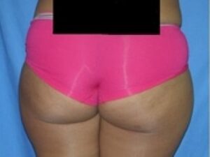 Before Image: Buttock Augmentation