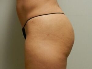 After Image: Buttock Augmentation