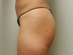 Before Image: Buttock Augmentation