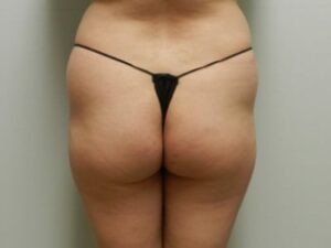 Before Image: Buttock Augmentation