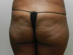 Before Image: Buttock Augmentation