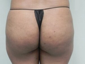 Before Image: Buttock Augmentation