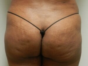 After Image: Buttock Augmentation