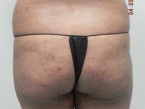 Before Image: Buttock Augmentation