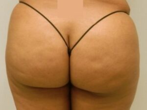 After Image: Buttock Augmentation