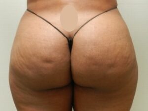 After Image: Buttock Augmentation