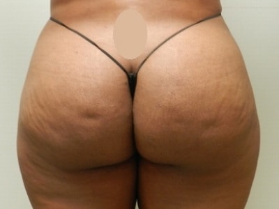 After Image: Buttock Augmentation - back