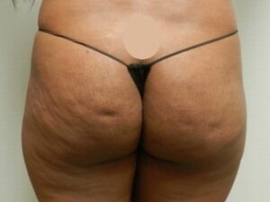 Before Image: Buttock Augmentation
