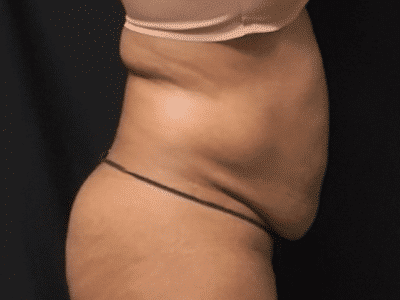 Before Image: Bella Body Lift - right-side