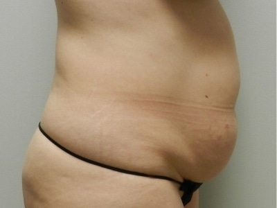 Before Image: Bella Body Lift - right-side