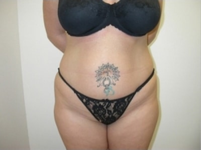 Before Image: Bella Body Lift - front