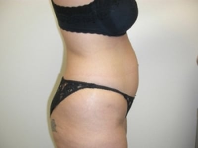 Before Image: Bella Body Lift - right-side