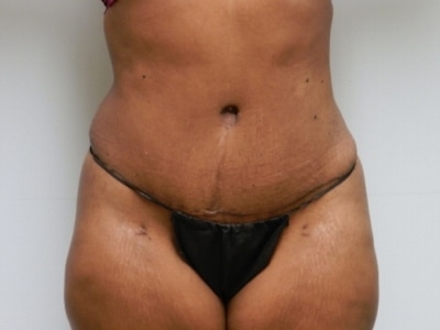 After Image: Bella Body Lift - front