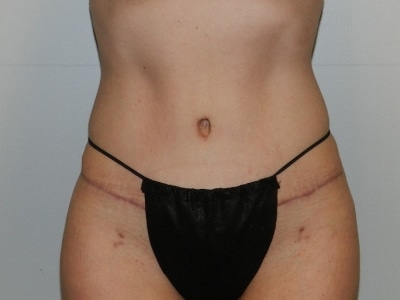 After Image: Bella Body Lift - front