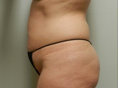 Before Image: Bella Body Lift - left-side