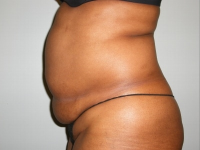 Before Image: Bella Body Lift - left-side