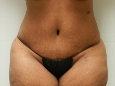 After Image: Bella Body Lift - front