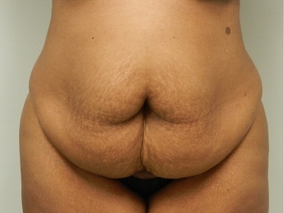 Before Image: Bella Body Lift - front