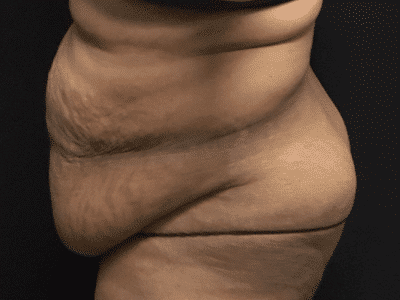 Before Image: Bella Body Lift - left-side