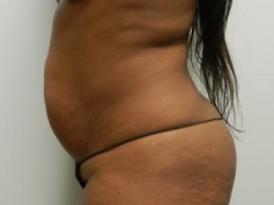 Before Image: Bella Body Lift - left-side