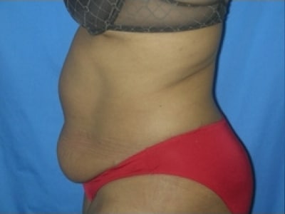 Before Image: Bella Body Lift - left-side