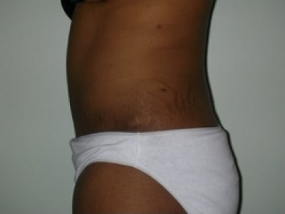 After Image: Bella Body Lift - left-side