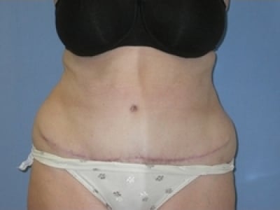 After Image: Bella Body Lift - front