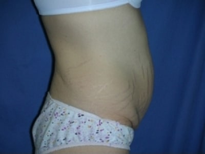 Before Image: Bella Body Lift - right-side