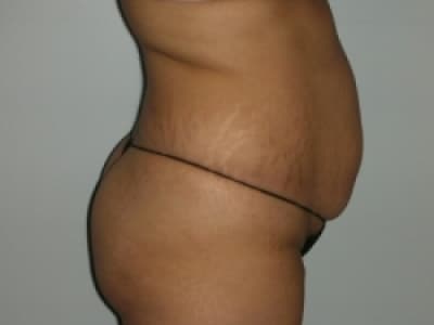 Before Image: Bella Body Lift - right-side