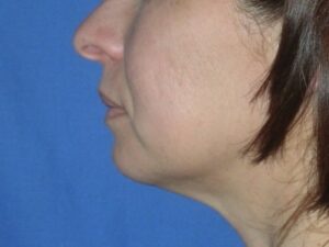 After Image: Chin Augmentation