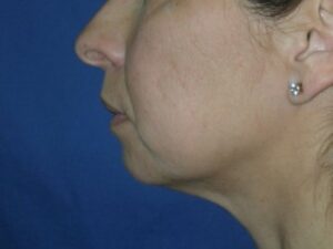 Before Image: Chin Augmentation