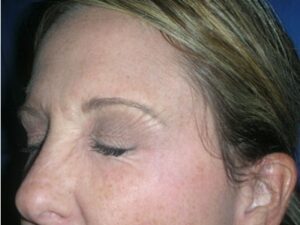After Image: BOTOX Cosmetic