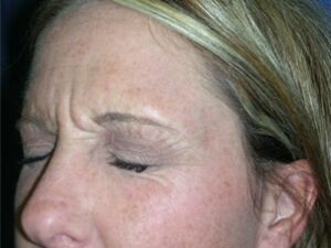 Before Image: BOTOX Cosmetic