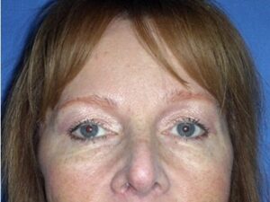 After Image: BOTOX Cosmetic