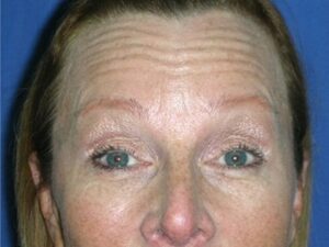 Before Image: BOTOX Cosmetic