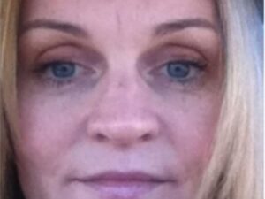 After Image: BOTOX Cosmetic