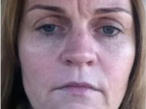 Before Image: BOTOX Cosmetic