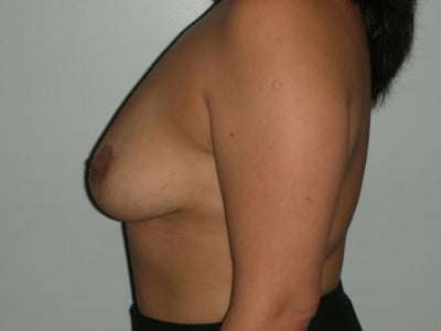 Before Image: Breast Augmentation With Mastopexy - left-side