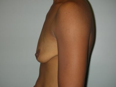 Before Image: Breast Augmentation With Mastopexy - left-side