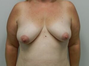 Before Image: Breast Augmentation With Mastopexy
