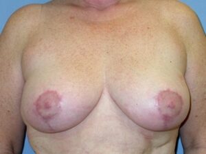 After Image: Breast Augmentation With Mastopexy